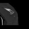 SPORK, NICO - 22.03.1976 - 02.08.2022 - CT obere Extremität - 18:01:46